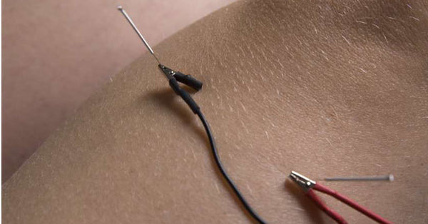 Acupuncture Treatment for Acne